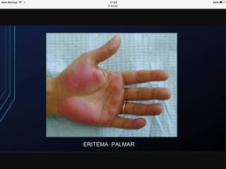 ERITEMA PALMAR
 