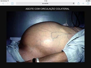 ASCITE COM CIRCULAÇÃO COLATERAL
 