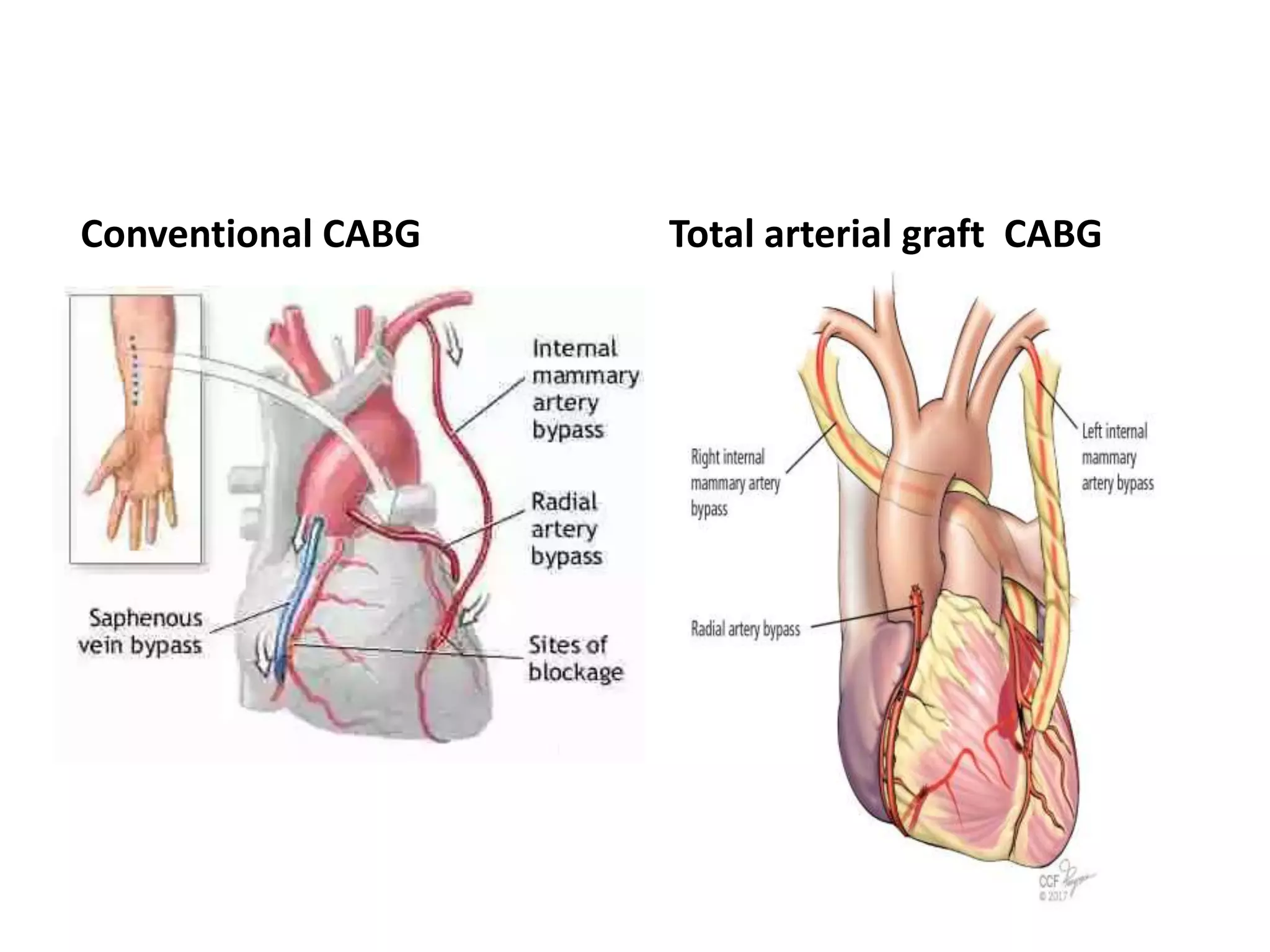 Recent Advances in Cardiothoracic Surgery | PPTX