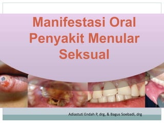 1
Manifestasi Oral
Penyakit Menular
Seksual
Adiastuti Endah P, drg, & Bagus Soebadi, drg
 