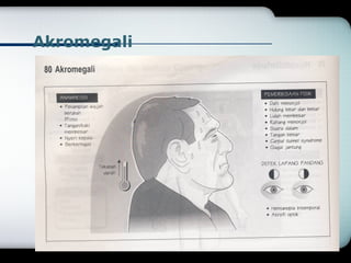 Akromegali 
 
