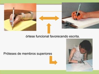 1414
Próteses de membros superiores
órtese funcional favorecendo escrita.
 