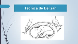 Técnica de Belizán
 