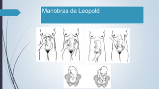 Manobras de Leopold
 
