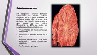Cistoadenomas serosos:
son neoplasias quísticas benignas
compuestas
de
células
cúbicas
cargadas de glucógeno alrededor de
pequeños quistes (de 1 a 3 mm), que
contienen un líquido transparente y
poco
espeso
de
color
pajizo.
Representa el 25% de todas las
neoplasias quísticas del páncreas.

•

•
•
•

Predominancia en mujeres mas que
en hombres.
habitual en la séptima década de la
vida.
Síntomas inespecíficos como dolor
abdominal o masas abdominales
palpables.
Tto: Resección quirúrgica

 