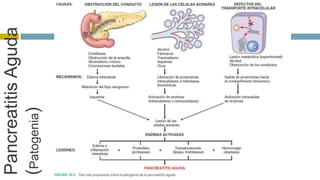 Pancreatitis Aguda 
(Patogenia) 
 