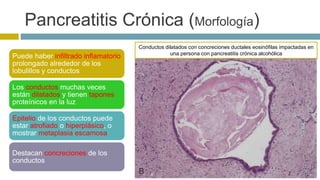 Pancreatitis Crónica (Morfología) 
Puede haber infiltrado inflamatorio 
prolongado alrededor de los 
lobulillos y conductos 
Los conductos muchas veces 
están dilatados y tienen tapones 
proteínicos en la luz 
Epitelio de los conductos puede 
estar atrofiado o hiperplásico, o 
mostrar metaplasia escamosa 
Destacan concreciones de los 
conductos 
Conductos dilatados con concreciones ductales eosinófilas impactadas en 
una persona con pancreatitis crónica alcohólica 
 