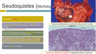 Seudoquistes (Morfología) 
Normalmente solitarios 
Pueden estar dentro del parénquima o en el epiplón menor o 
zona retroperitoneal entre el estómago y colon transverso o 
el hígado 
• Pueden estar incluso subdiafragmáticos 
Se forman por tabicación mediante tejido fibroso de zonas de 
necrosis grasa hemorrágica peripancreática 
Se componen de material central necrótico – hemorrágico 
cargado de enzimas pancreáticas y rodeado por paredes 
fibrosas de tejido de granulación no revestidas de epitelio 
Tamaño: 2-30cm de diámetro 
Quiste mal delimitado con pared necrótica de color marrón 
negruzco 
Carece de revestimiento epitelial  tapizado de fibrina y tejido de 
granulación 
 