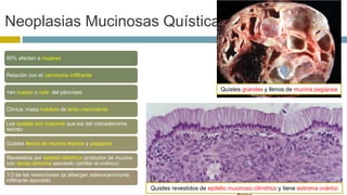 Neoplasias Mucinosas Quísticas 
95% afectan a mujeres 
Relación con el carcinoma infiltrante 
+en cuerpo o cola del páncreas 
Clínica: masa indolora de lento crecimiento 
Los quistes son mayores que los del cistoadenoma 
seroso 
Quistes llenos de mucina espesa y pegajosa 
Revestidos por epitelio cilíndrico productor de mucina 
con denso estroma asociado (similar al ovárico) 
1/3 de las resecciones qx albergan adenocarcinoma 
infiltrante asociado 
Quistes grandes y llenos de mucina pegajosa 
Quistes revestidos de epitelio mucinoso cilíndrico y tiene estroma ovárico 
denso 
 