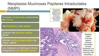 Neoplasias Mucinosas Papilares Intraductales 
(NMPI) 
Tumores intraductales productores 
de mucina 
+en hombres y +en cabeza 
Carecen del estroma ovárico 
denso 
Afectan conducto pancreático de 
mayor calibre 
Las malignas se distinguen de las 
benignas por la infiltración tisular 
Neoplasia 
papilar que 
distiende el 
conducto 
pancreático 
principal 
Neiplasia 
papilar 
mucinosa 
aafecta 
conducto 
pancreático 
principal 
(izquierda) y se 
extiende hacia 
conductos más 
pequeños y 
conductillos 
 