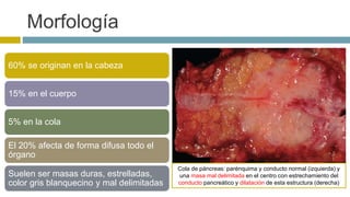 Morfología 
60% se originan en la cabeza 
15% en el cuerpo 
5% en la cola 
El 20% afecta de forma difusa todo el 
órgano 
Suelen ser masas duras, estrelladas, 
color gris blanquecino y mal delimitadas 
Cola de páncreas: parénquima y conducto normal (izquierda) y 
una masa mal delimitada en el centro con estrechamiento del 
conducto pancreático y dilatación de esta estructura (derecha) 
 