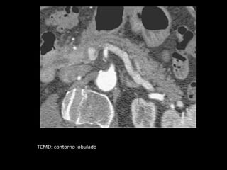 TCMD: contorno lobulado
 