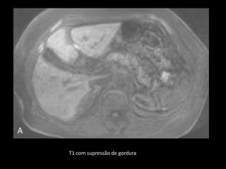 T1 com supressão de gordura
 
