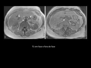 T1 em fase e fora de fase
 
