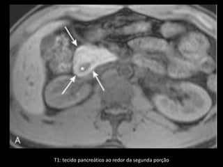 T1: tecido pancreático ao redor da segunda porção
 