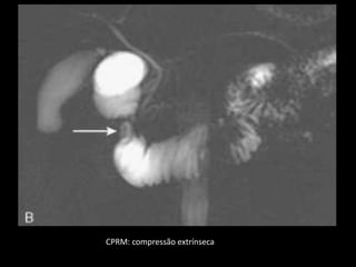 CPRM: compressão extrínseca
 