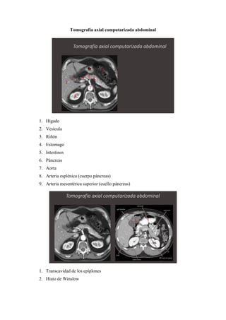 Tomografía axial computarizada abdominal
1. Hígado
2. Vesícula
3. Riñón
4. Estomago
5. Intestinos
6. Páncreas
7. Aorta
8. Arteria esplénica (cuerpo páncreas)
9. Arteria mesentérica superior (cuello páncreas)
1. Transcavidad de los epiplones
2. Hiato de Winslow
1
2
 