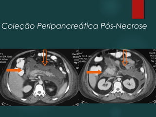 Coleção Peripancreática Pós-Necrose
 