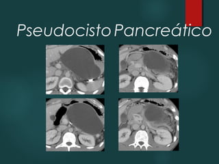 PseudocistoPancreático
 