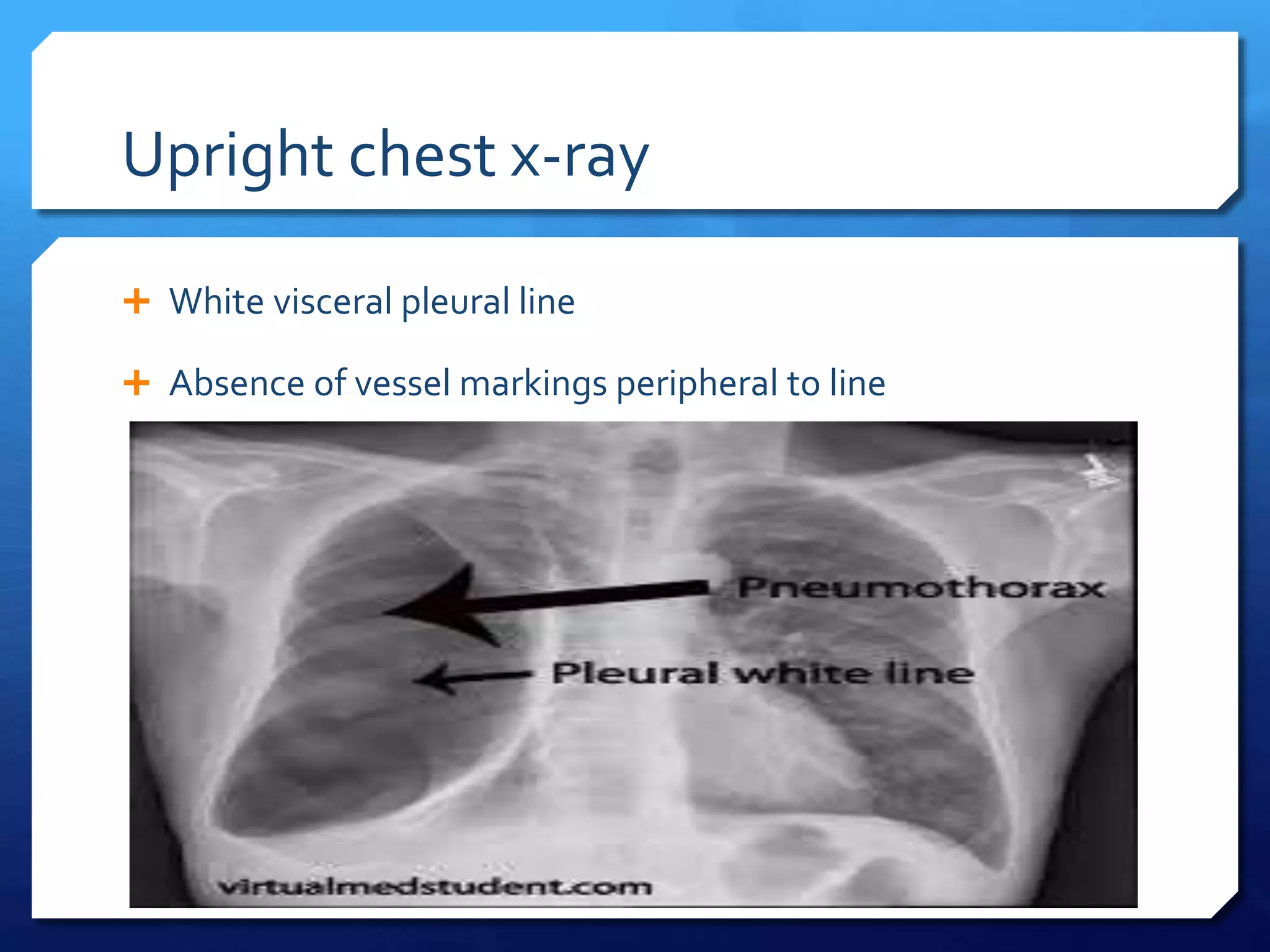 Upright chest x-ray
 White visceral pleural line
 Absence of vessel markings peripheral to line
 
