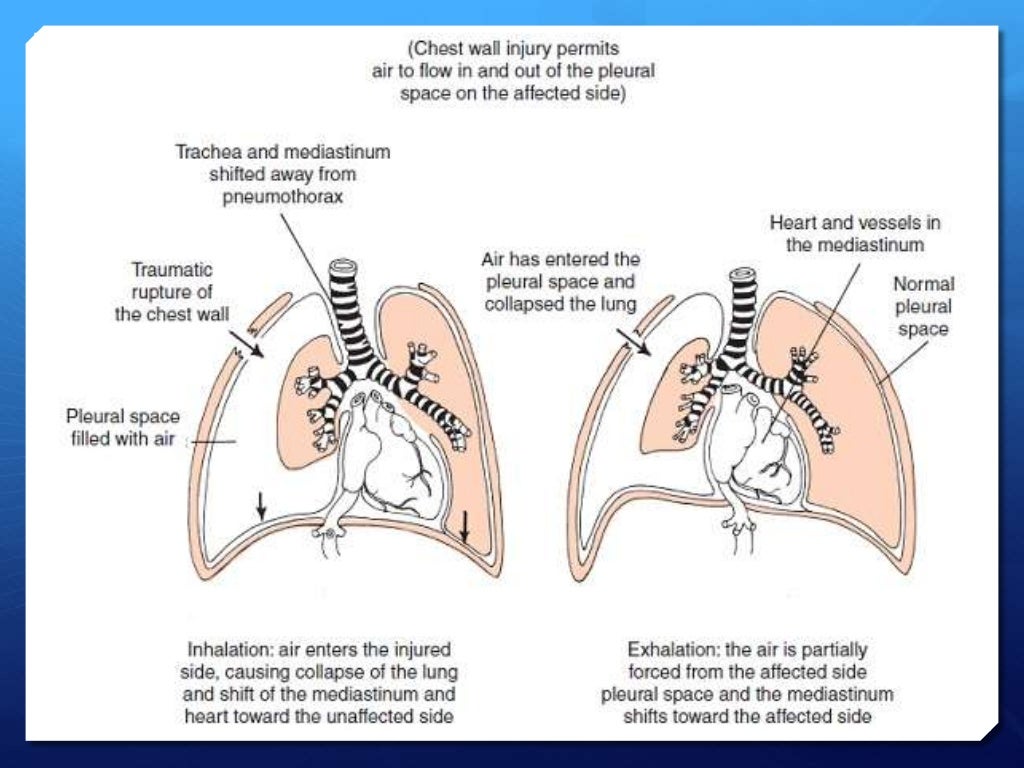 Pneomothorax & hemothorax by Farshid Mokhberi