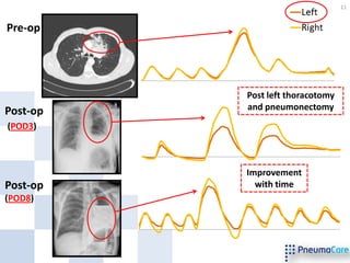 11


Pre-op




          Post left thoracotomy
Post-op   and pneumonectomy
(POD3)



          Improvement
Post-op     with time
(POD8)
 