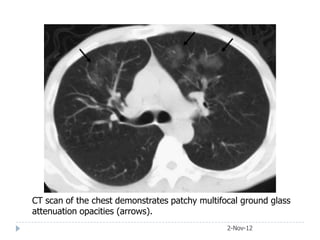 CT scan of the chest demonstrates patchy multifocal ground glass
attenuation opacities (arrows).
                                                2-Nov-12
 