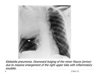 Klebsiella pneumonia. Downward bulging of the minor fissure (arrow)
due to massive enlargement of the right upper lobe with inflammatory
exudate.
                                                   2-Nov-12
 