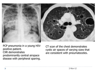 PCP pneumonia in a young HIV-      CT scan of the chest demonstrates
positive patient.                  cystic air spaces of varying sizes that
CXR demonstrates                   are consistent with pneumatoceles.
predominantly central airspace
disease with peripheral sparing.


                                                       2-Nov-12
 