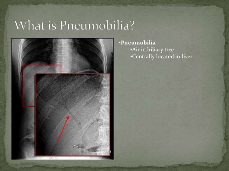 pneumobilia 1 pneumobilia