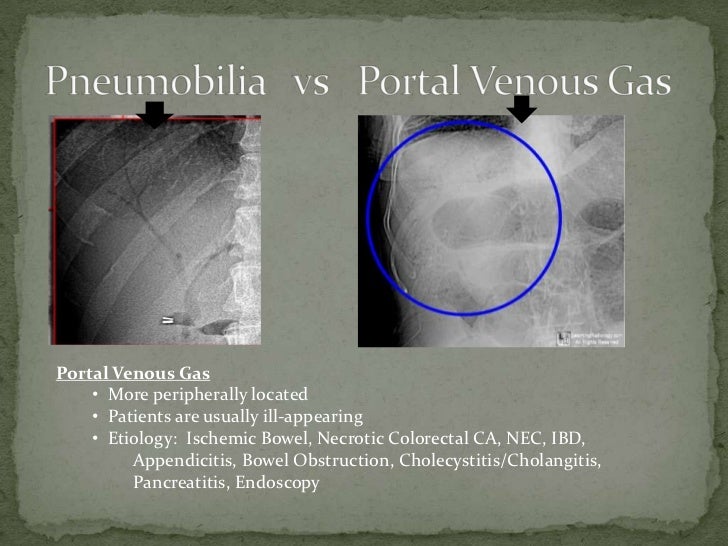pneumobilia 1 pneumobilia
