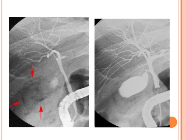 pneumobilia vs portal vein gas pneumobilia