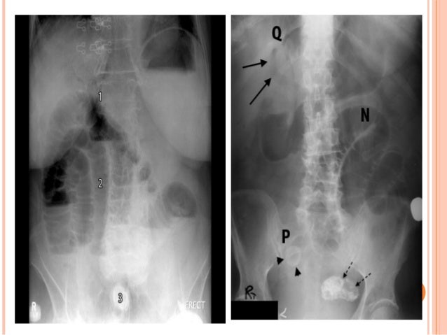 pneumobilia vs portal vein gas pneumobilia