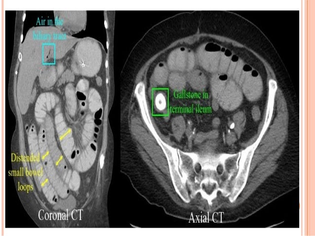 pneumobilia vs portal vein gas pneumobilia