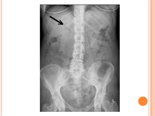 pneumobilia vs portal vein gas pneumobilia
