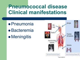 Pneumococcal disease
Clinical manifestations
 Pneumonia
 Bacteremia
 Meningitis
 