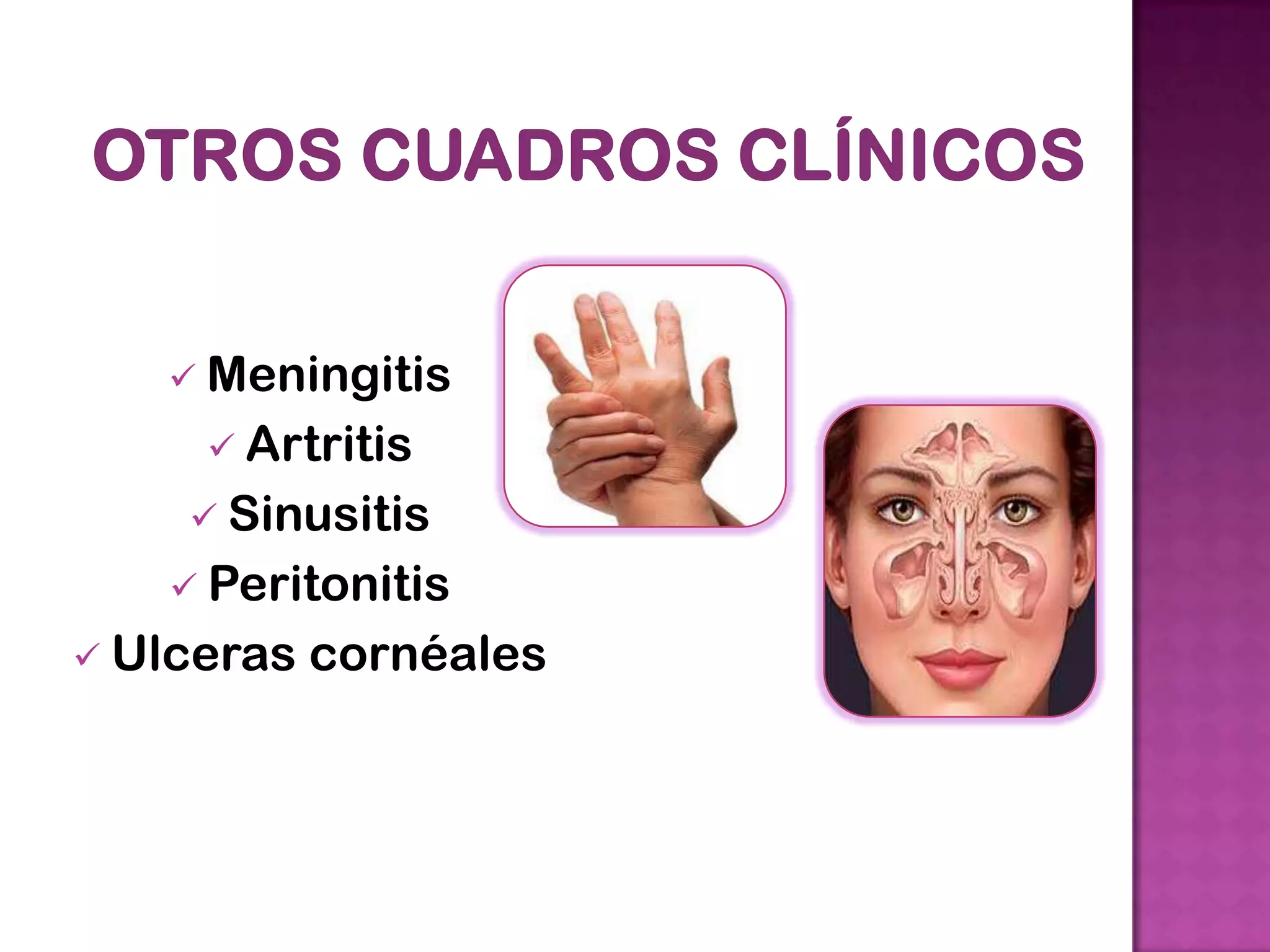  Meningitis
Artritis
Sinusitis
Peritonitis
Ulceras cornéales
