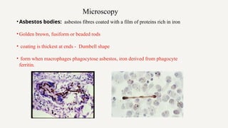 Fuiform Rods Comprehensive Overview of Pneumoconiosis: Pathogenesis, Types, and ...