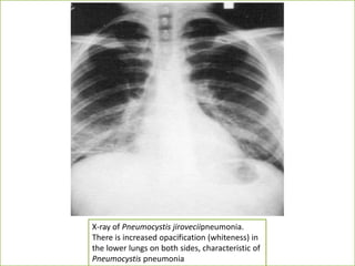 X-ray of Pneumocystis jiroveciipneumonia.
There is increased opacification (whiteness) in
the lower lungs on both sides, characteristic of
Pneumocystis pneumonia
 