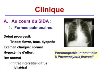 Clinique
A. Au cours du SIDA :
   1. Formes pulmonaires:

Début progressif:
    Triade: fièvre, toux, dyspnée
Examen clinique: normal
Hypoxémie d’effort                 Pneumopathie interstitielle
Rx: normal                         à Pneumocystis jirovecii
   infiltrat interstitiel diffus
       bilatéral
 