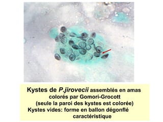 Kystes de P.jirovecii assemblés en amas
        colorés par Gomori-Grocott
  (seule la paroi des kystes est colorée)
Kystes vides: forme en ballon dégonflé
                 caractéristique
 