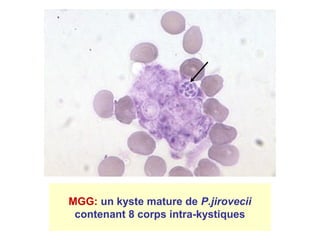 MGG: un kyste mature de P.jirovecii
 contenant 8 corps intra-kystiques
 