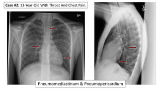 Case #4: 25-Year Old With Repeated Episodes Of
Vomiting.
Pneumomediastinum
 
