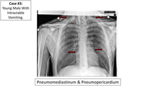 EMGuideWire's Radiology Reading Room: Pneumomediastinum