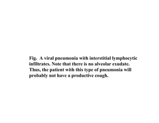Pneumonia