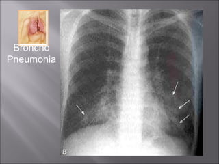 Broncho Pneumonia 