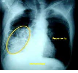 Pneumonia




Immunology
 