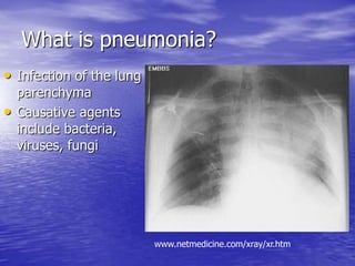 Pneumonia
I. Reduction in the total available surface area
of the respiratory membrane
II. Decreased ventilation-perfusion...