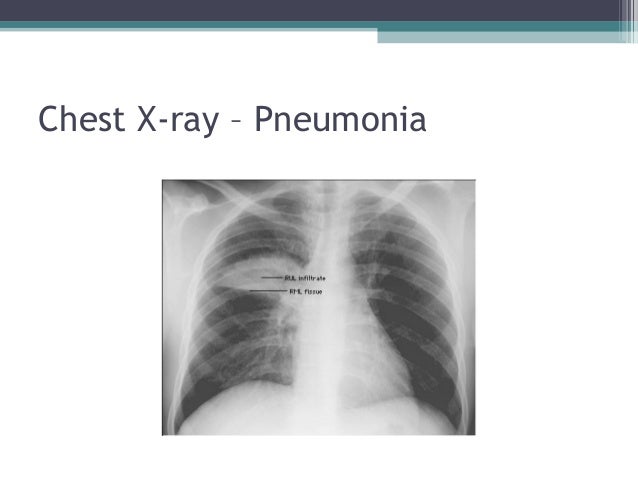 bacterial pneumonia chest x ray findings bacterial pneumonia chest x ray findings