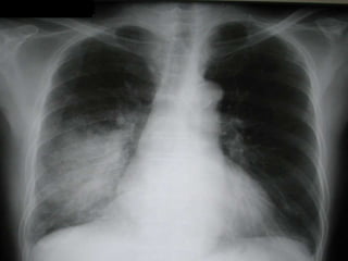 Community acquired pneumonia
(CAP)
Spread by droplet infection
 Occurs in previously healthy patients
 Once the organism...